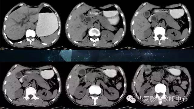 【病例】IgG4相关性胰腺炎、胆管炎、胆囊炎一例