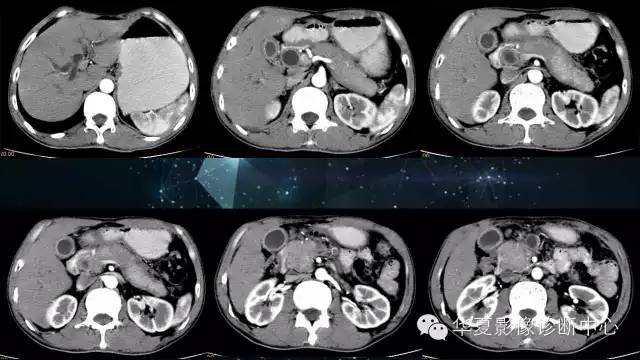 【病例】IgG4相关性胰腺炎、胆管炎、胆囊炎一例