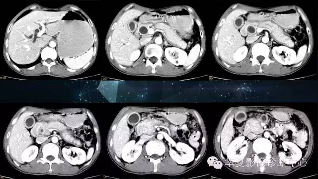 【病例】IgG4相关性胰腺炎、胆管炎、胆囊炎一例