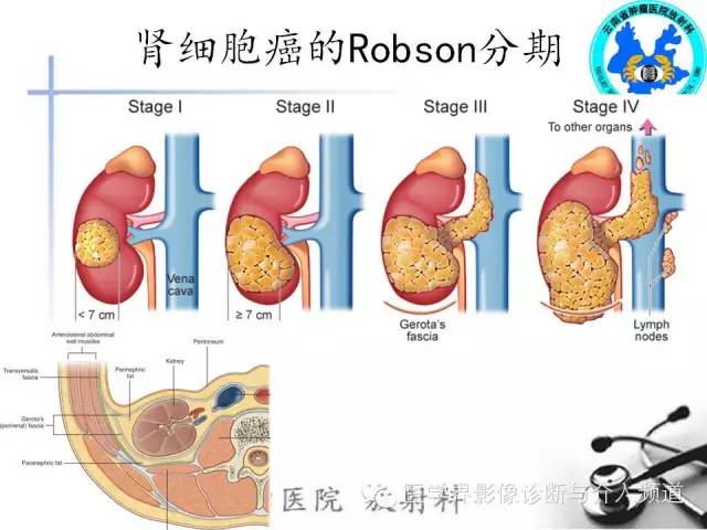 【PPT】肾脏肿瘤的临床分期及CT影像价值
