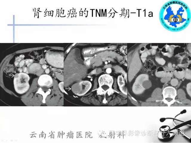 【PPT】肾脏肿瘤的临床分期及CT影像价值