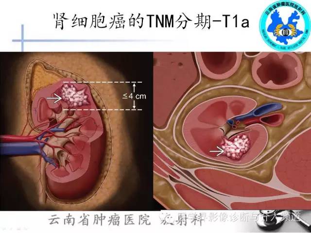 【PPT】肾脏肿瘤的临床分期及CT影像价值