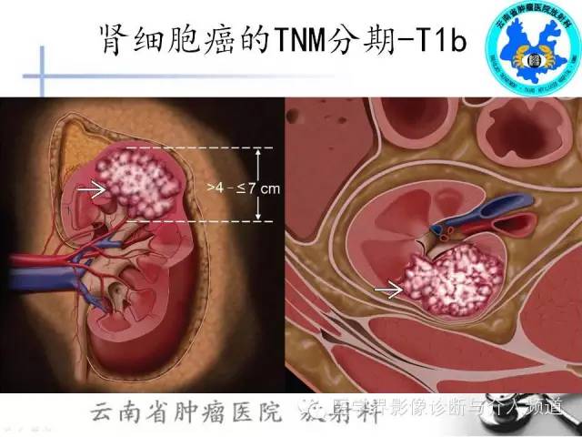 【PPT】肾脏肿瘤的临床分期及CT影像价值