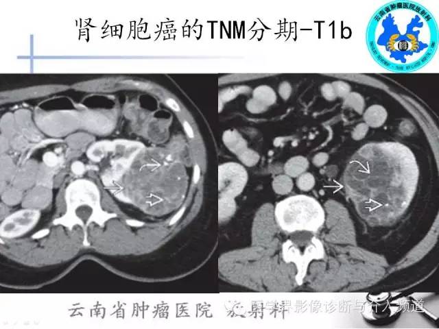 【PPT】肾脏肿瘤的临床分期及CT影像价值