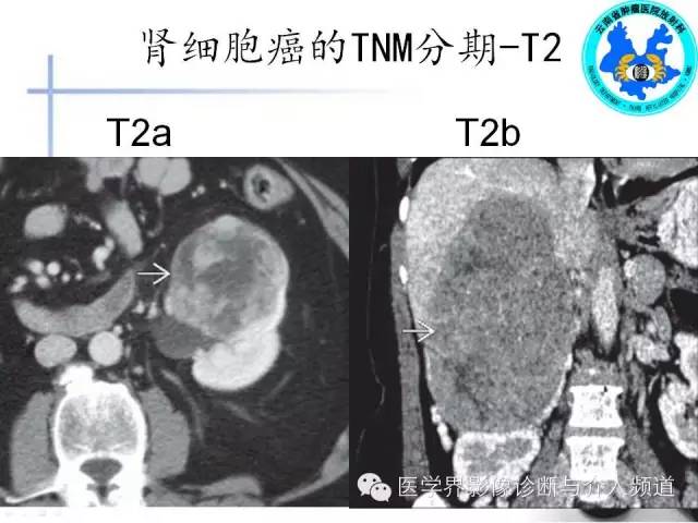 【PPT】肾脏肿瘤的临床分期及CT影像价值