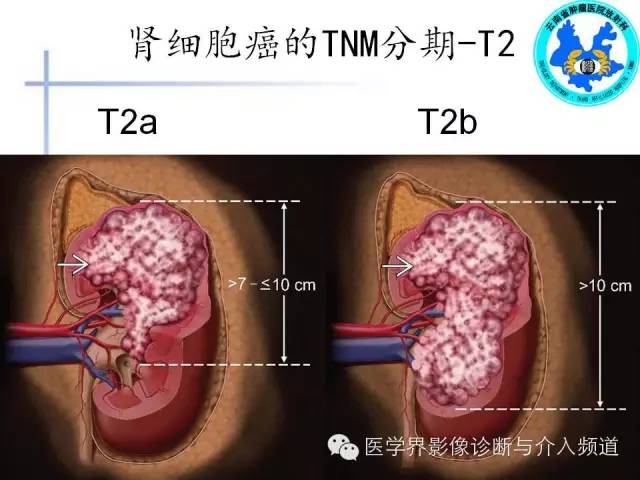 【PPT】肾脏肿瘤的临床分期及CT影像价值