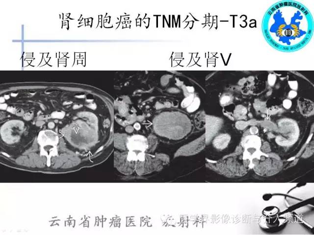 【PPT】肾脏肿瘤的临床分期及CT影像价值