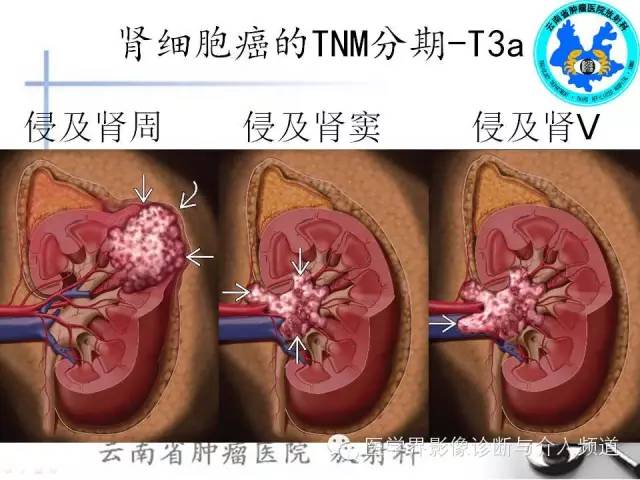 【PPT】肾脏肿瘤的临床分期及CT影像价值