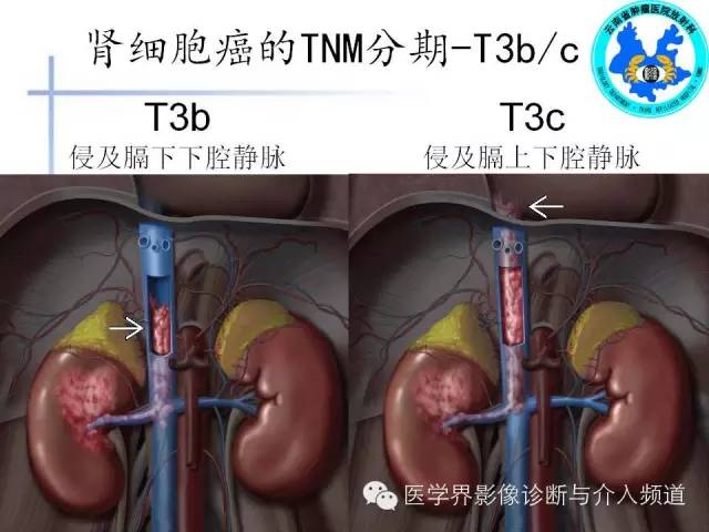 【PPT】肾脏肿瘤的临床分期及CT影像价值