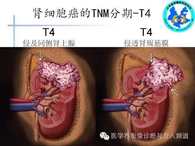 【PPT】肾脏肿瘤的临床分期及CT影像价值