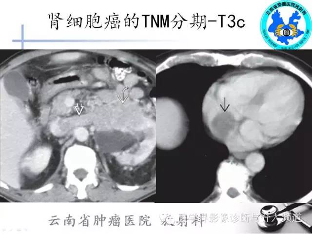 【PPT】肾脏肿瘤的临床分期及CT影像价值
