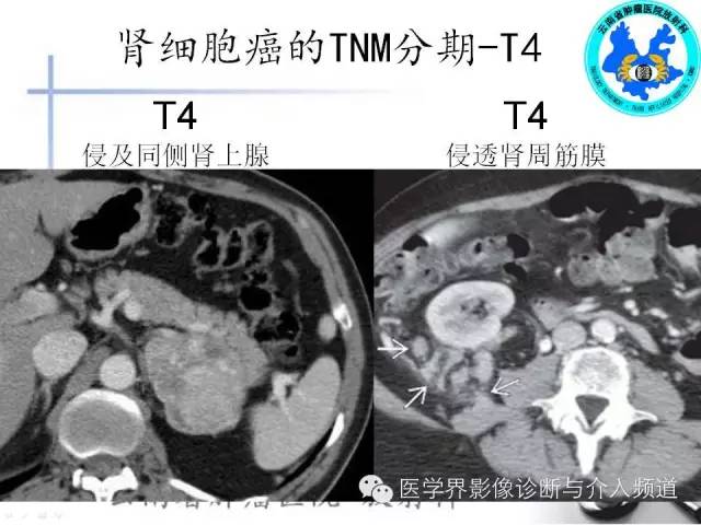 【PPT】肾脏肿瘤的临床分期及CT影像价值