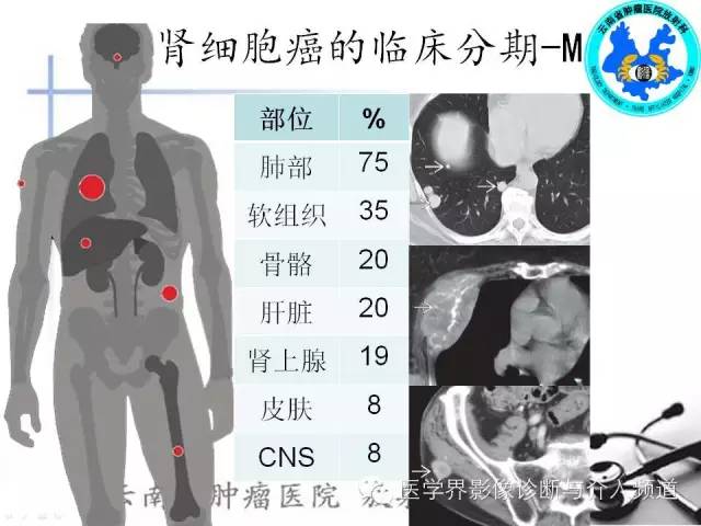 【PPT】肾脏肿瘤的临床分期及CT影像价值