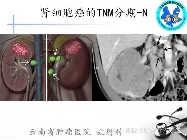 【PPT】肾脏肿瘤的临床分期及CT影像价值