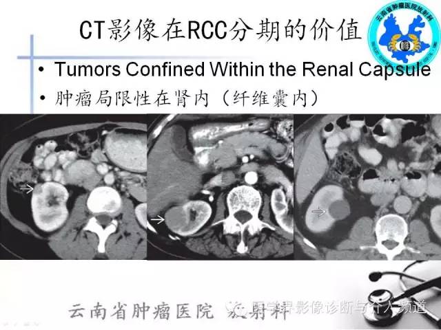 【PPT】肾脏肿瘤的临床分期及CT影像价值