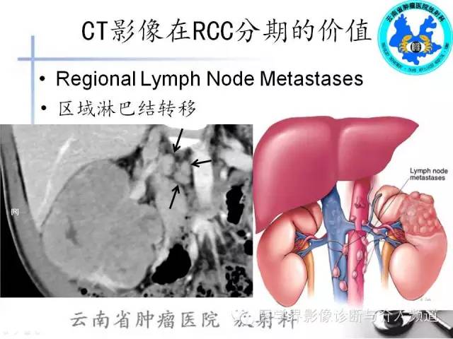 【PPT】肾脏肿瘤的临床分期及CT影像价值