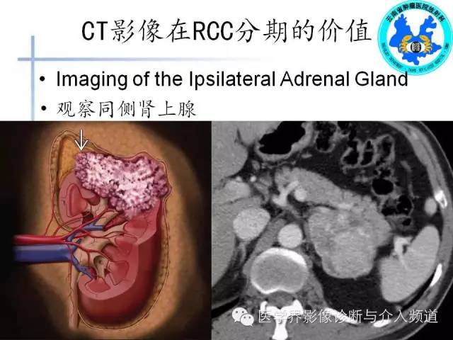 【PPT】肾脏肿瘤的临床分期及CT影像价值