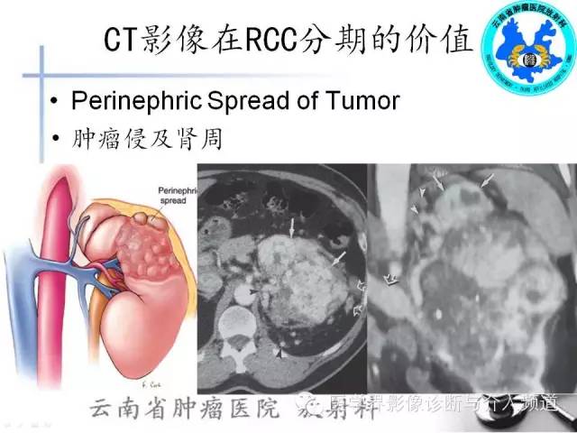 【PPT】肾脏肿瘤的临床分期及CT影像价值