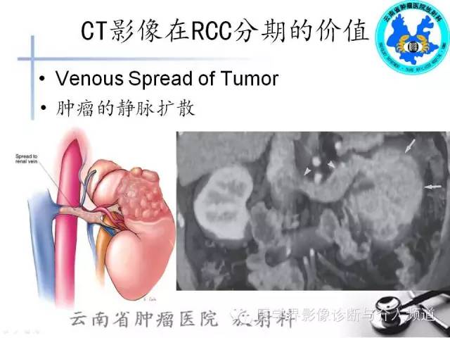 【PPT】肾脏肿瘤的临床分期及CT影像价值
