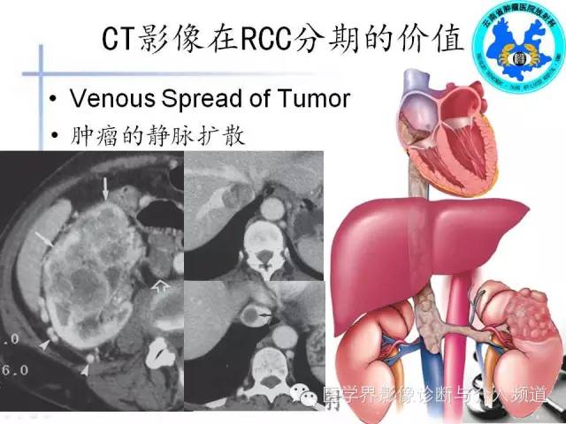 【PPT】肾脏肿瘤的临床分期及CT影像价值