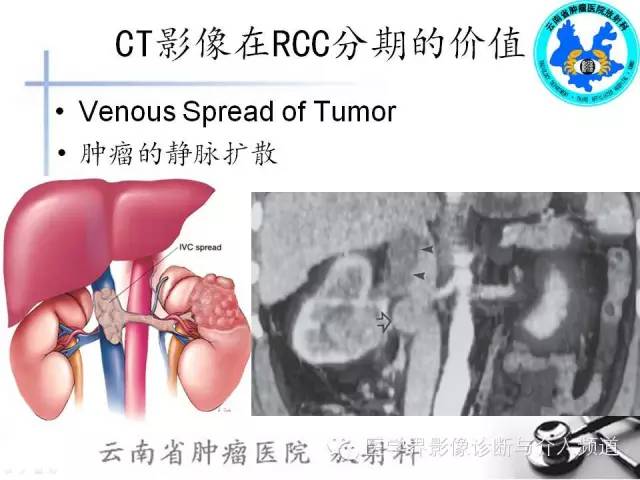 【PPT】肾脏肿瘤的临床分期及CT影像价值
