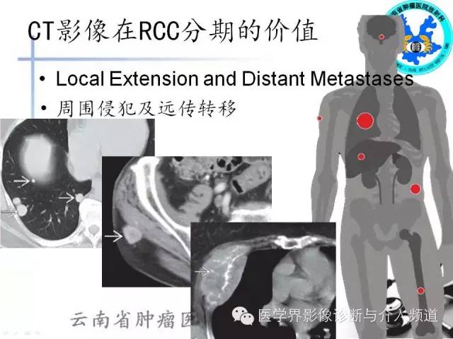 【PPT】肾脏肿瘤的临床分期及CT影像价值