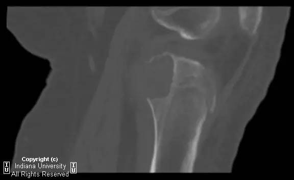 【病例】软骨母细胞瘤1例影像表现 【病例】软骨母细胞瘤1例影像表现