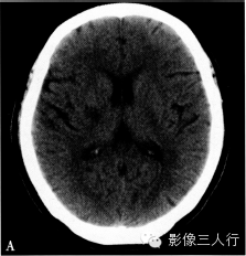 腔隙性脑梗死的诊断要点及鉴别诊断