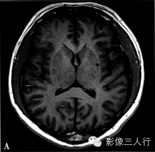 腔隙性脑梗死的诊断要点及鉴别诊断