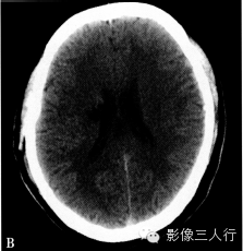 腔隙性脑梗死的诊断要点及鉴别诊断