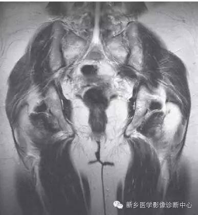 髋关节解剖+详细标注