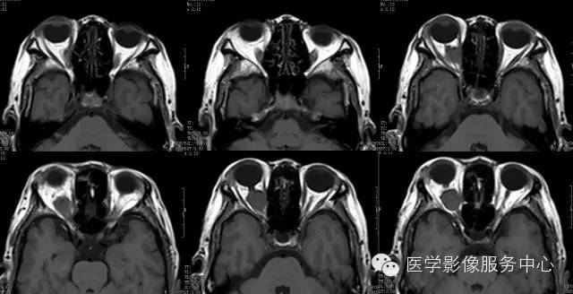 【病例】视神经鞘脑膜瘤1例CT及MR影像表现 【病例】视神经鞘脑膜瘤1例CT及MR影像表现
