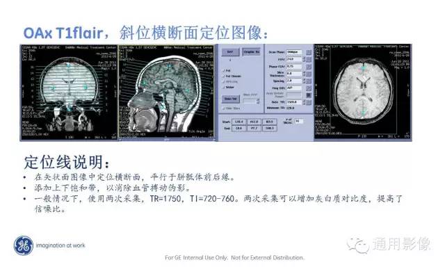 中枢神经系统波谱MRS