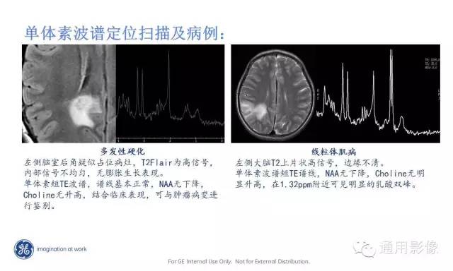 中枢神经系统波谱MRS
