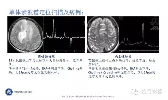 中枢神经系统波谱MRS