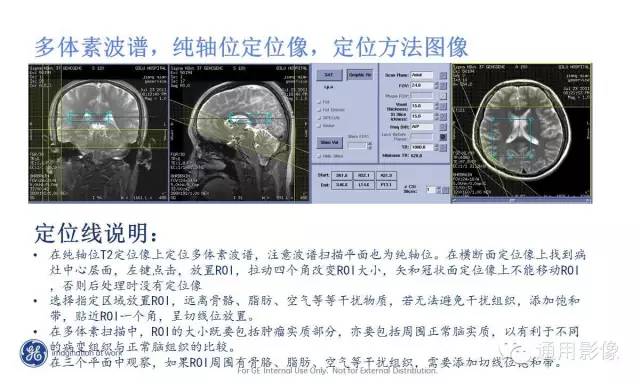 中枢神经系统波谱MRS