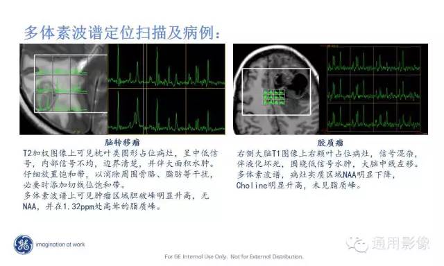 中枢神经系统波谱MRS