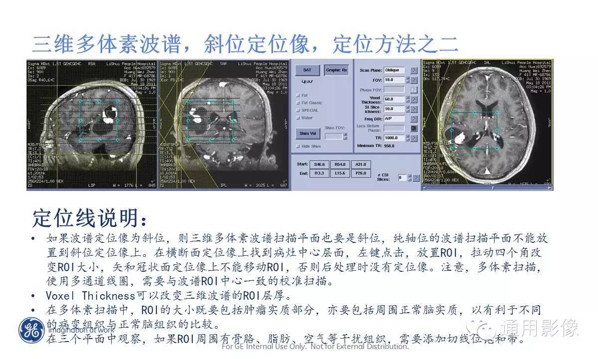 中枢神经系统波谱MRS