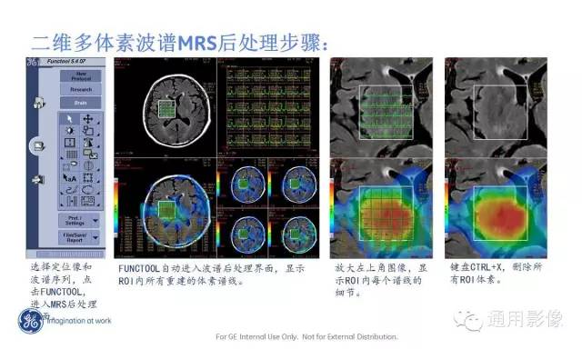 中枢神经系统波谱MRS