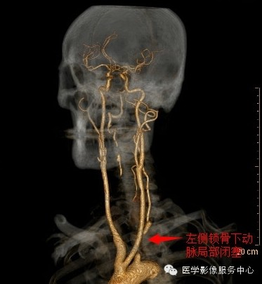 【病例】锁骨下动脉盗血综合征1例CT影像表现