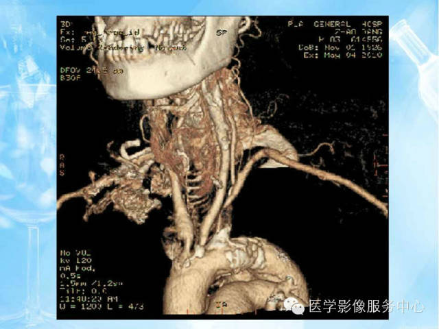 【病例】锁骨下动脉盗血综合征1例CT影像表现