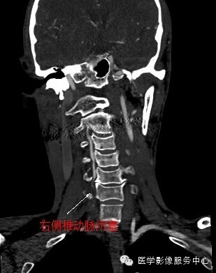 【病例】锁骨下动脉盗血综合征1例CT影像表现