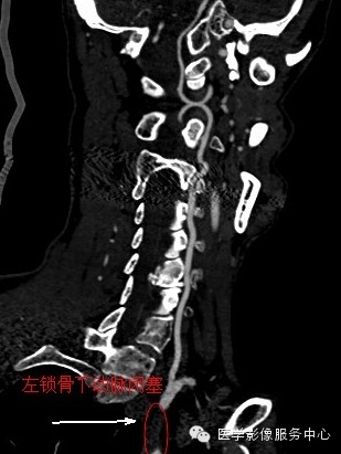 【病例】锁骨下动脉盗血综合征1例CT影像表现