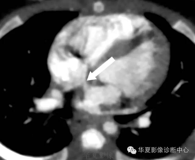 【病例】肺动脉吊带1例CT影像表现