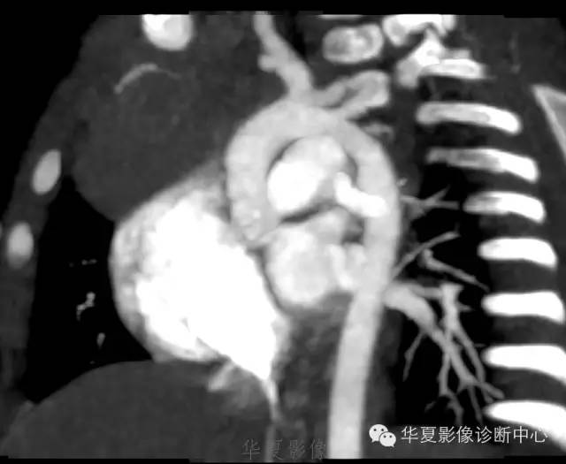 【病例】肺动脉吊带1例CT影像表现 【病例】肺动脉吊带1例CT影像表现