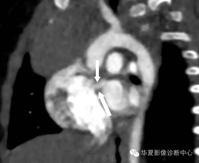 【病例】肺动脉吊带1例CT影像表现 【病例】肺动脉吊带1例CT影像表现