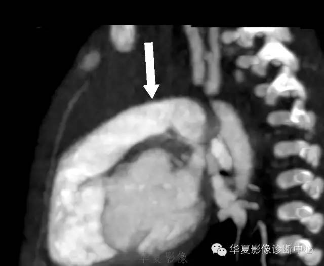 【病例】肺动脉吊带1例CT影像表现 【病例】肺动脉吊带1例CT影像表现