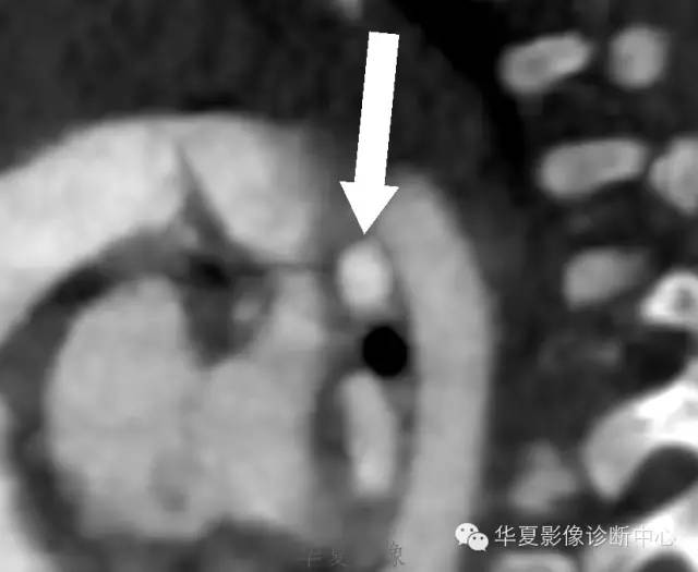 【病例】肺动脉吊带1例CT影像表现 【病例】肺动脉吊带1例CT影像表现