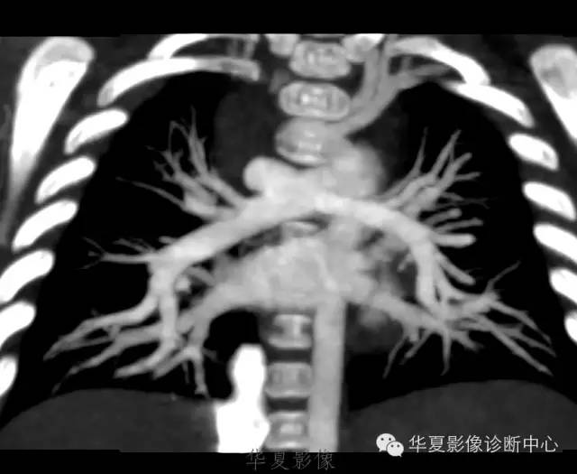 【病例】肺动脉吊带1例CT影像表现 【病例】肺动脉吊带1例CT影像表现