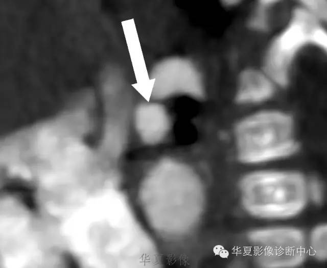 【病例】肺动脉吊带1例CT影像表现 【病例】肺动脉吊带1例CT影像表现